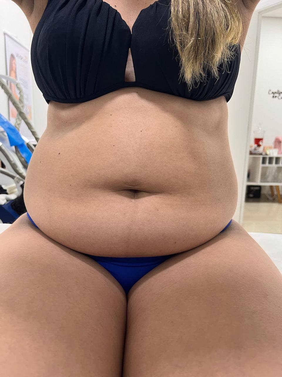 Antes - Diástase abdominal